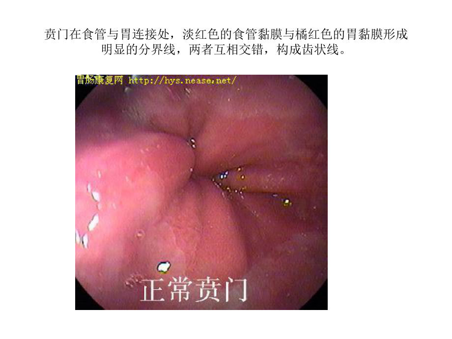 正常胃肠镜图片_第1页